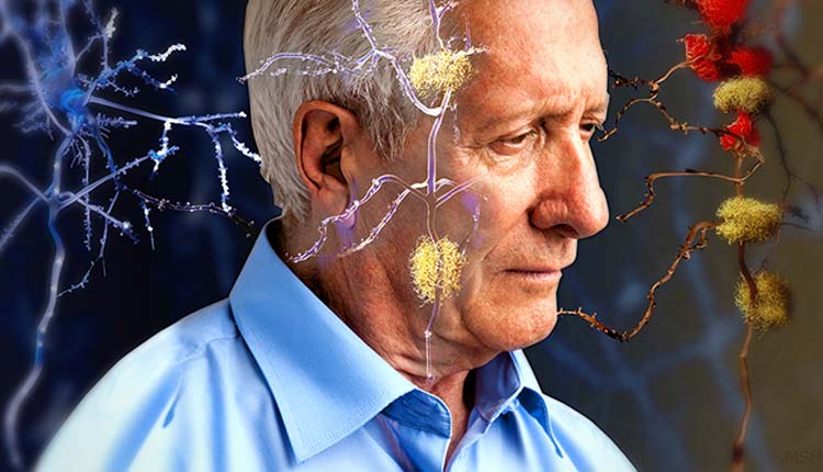 Alzheimer, Salud, Marca-pasos,